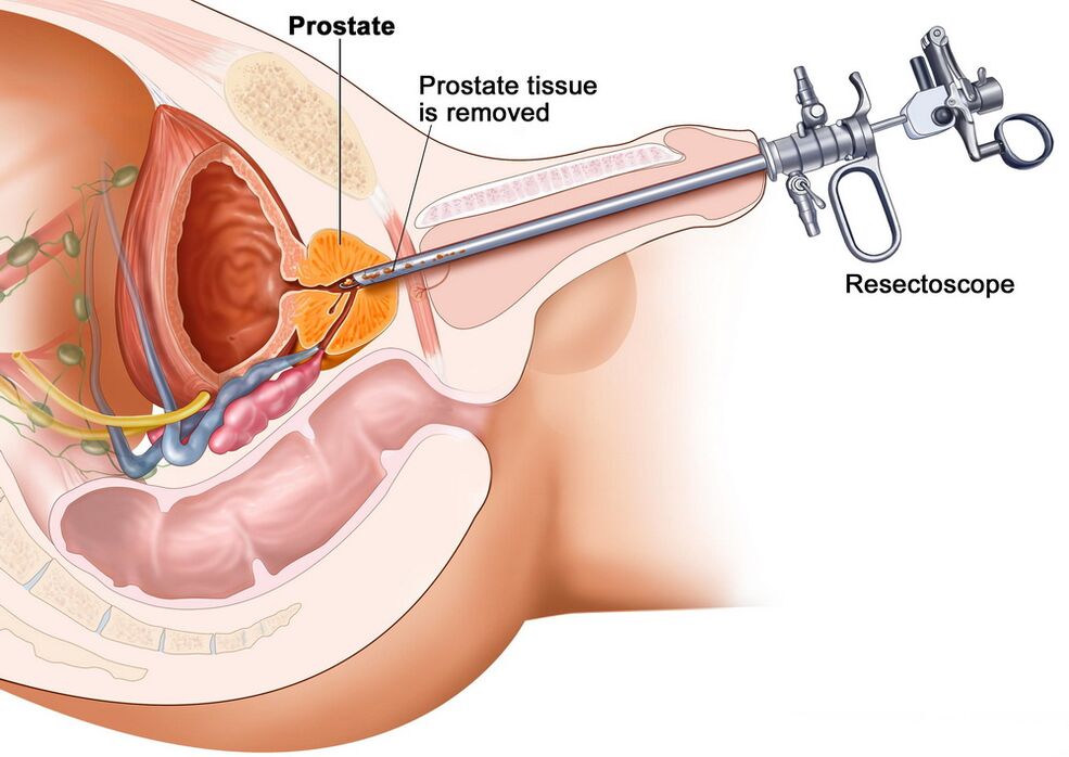 Rimozione del tessuto prostatico per una diagnosi accurata della prostatite