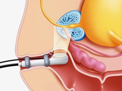 Biopsia della puntura della prostata